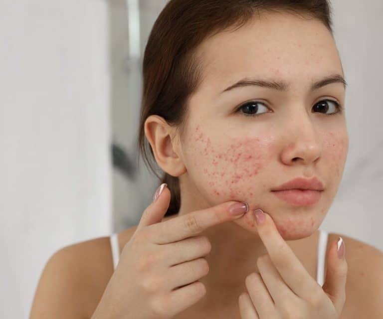Pourquoi traiter l'acné soi-même n'est pas recommandé ?