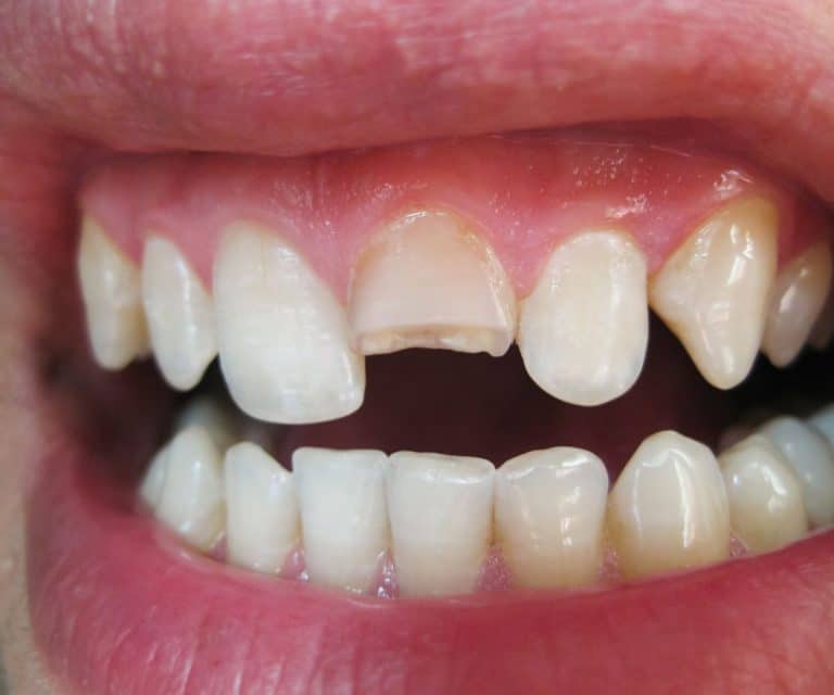 Dent Cassée : Que Faire En Attendant le Dentiste