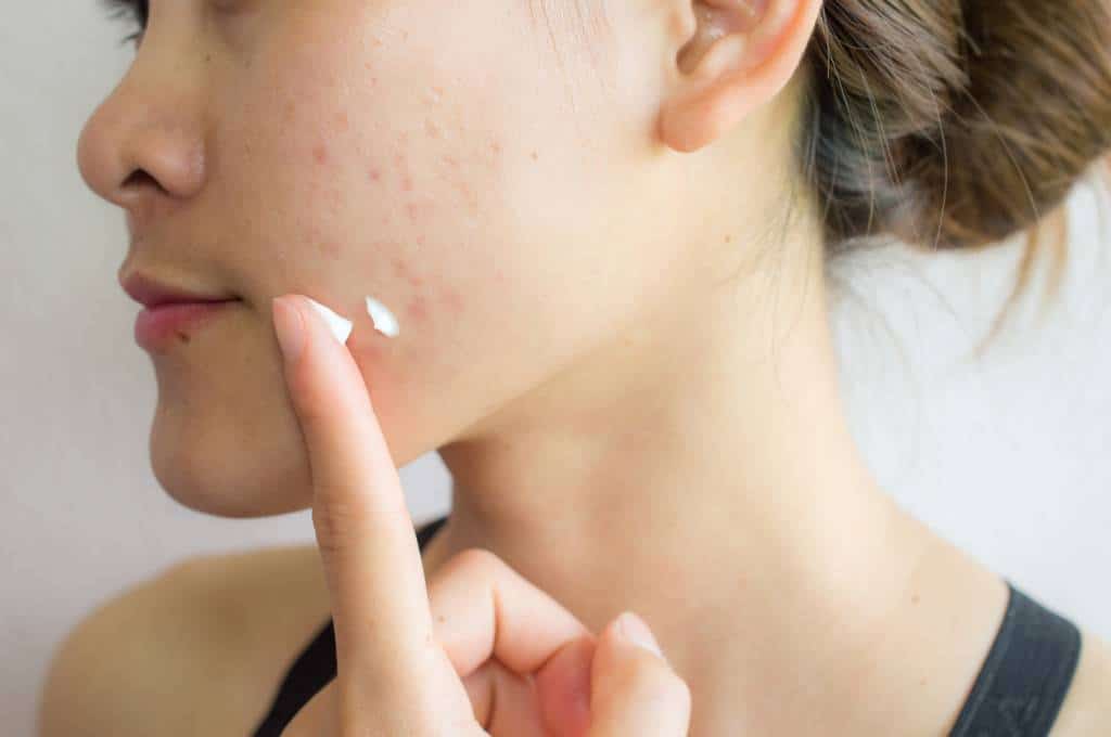 la cosmétique pour lutter contre l'acné sur tout le corps